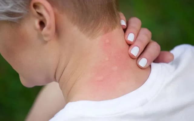 Alergia na gluten objawy skórne: jak je rozpoznać i leczyć